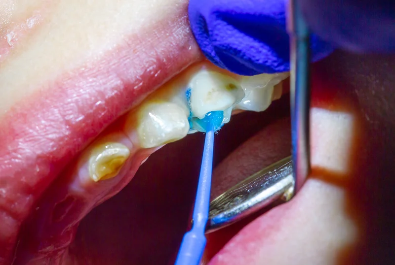 dental sealants Paso Robles