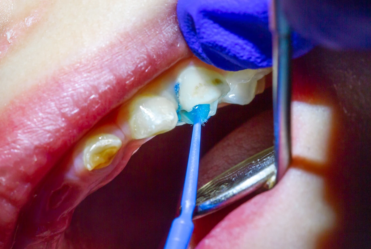 Treatment,Of,Baby,Teeth,In,A,Child,,Dental,Drill,,Installation dental sealants Paso Robles