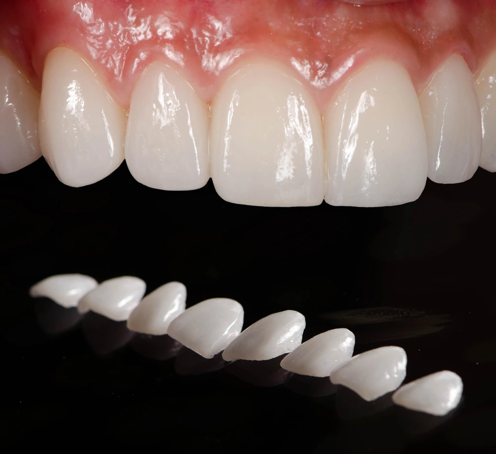 The,Dental,Ceramic,Veneer,In,Laboratory Close-up of teeth and dental veneers